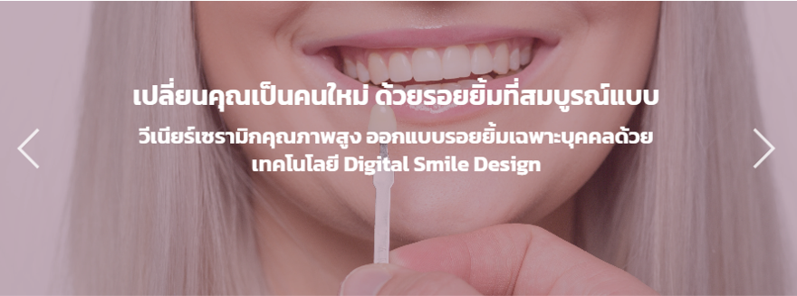 วีเนียร์ เคลือบผิวฟัน